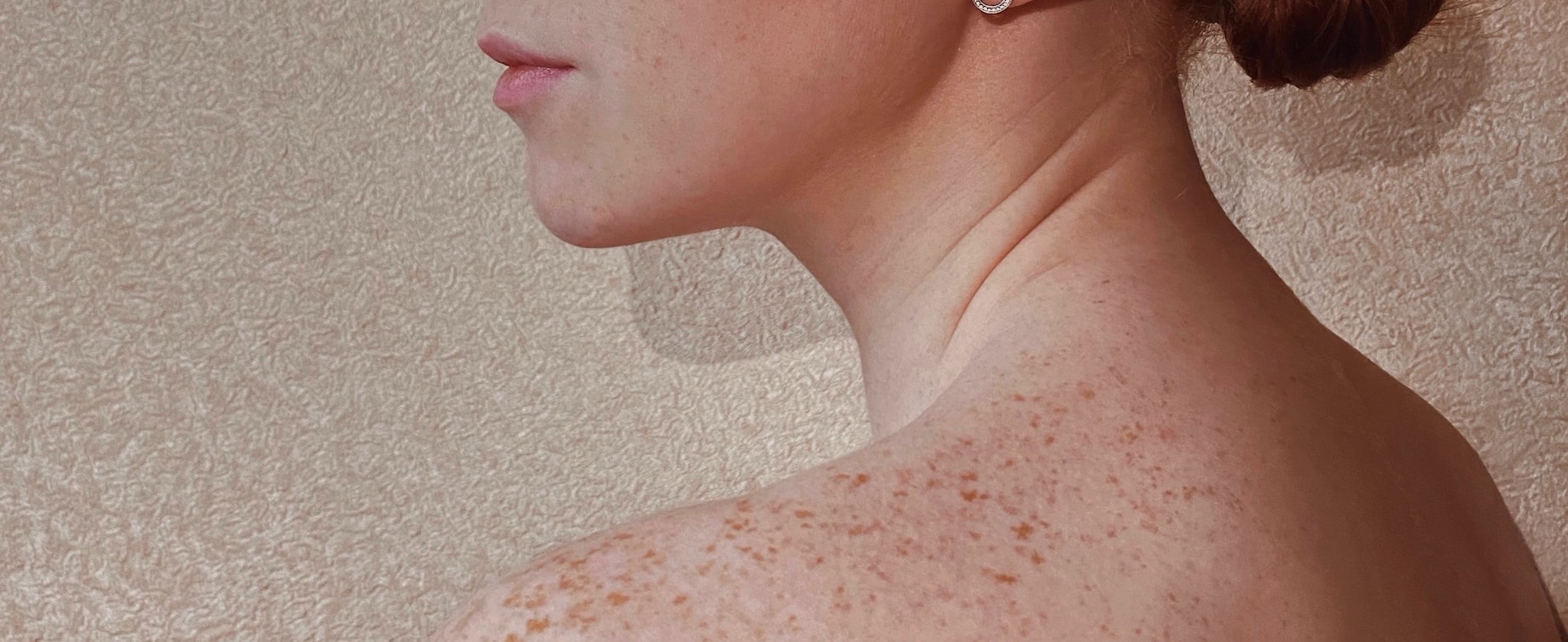 What Are The Different Types Of Eczema What Are The Different Types Of Eczema