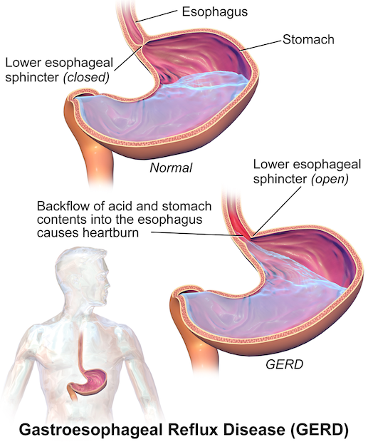 a diagram showing how GERD occurs