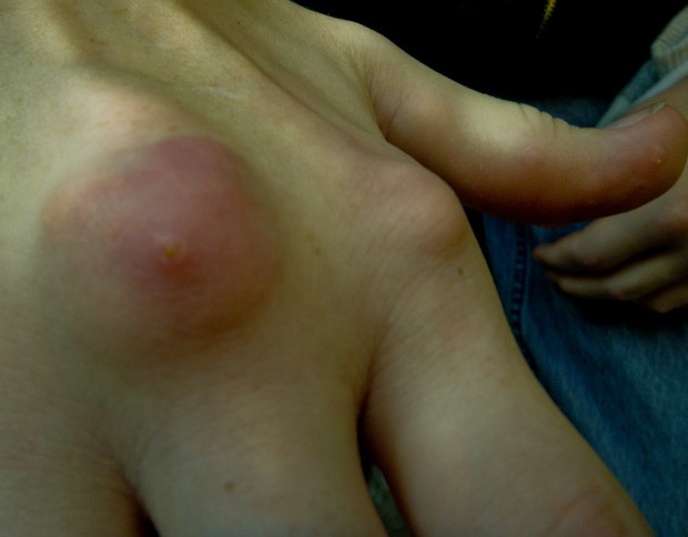 a person affected with tophaceous gout of the hand