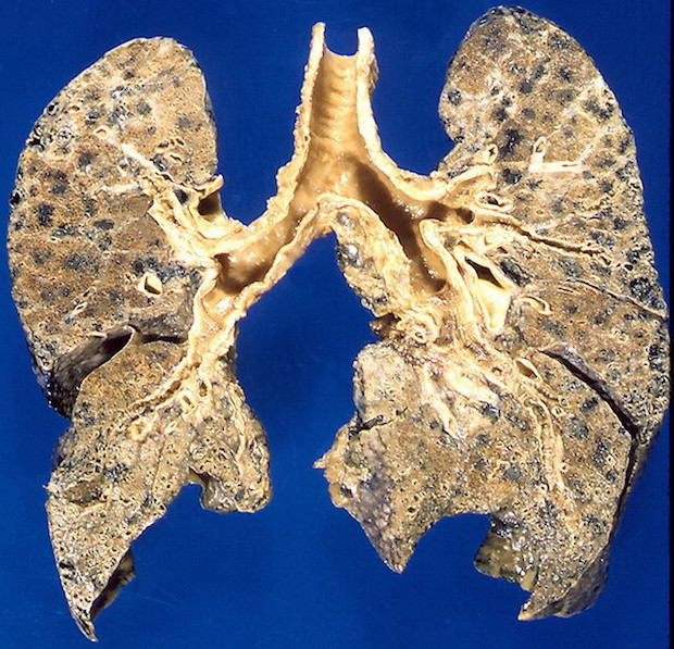 lungs affected by emphysema