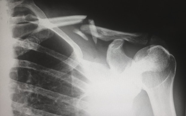 An x-ray showing a bone fracture