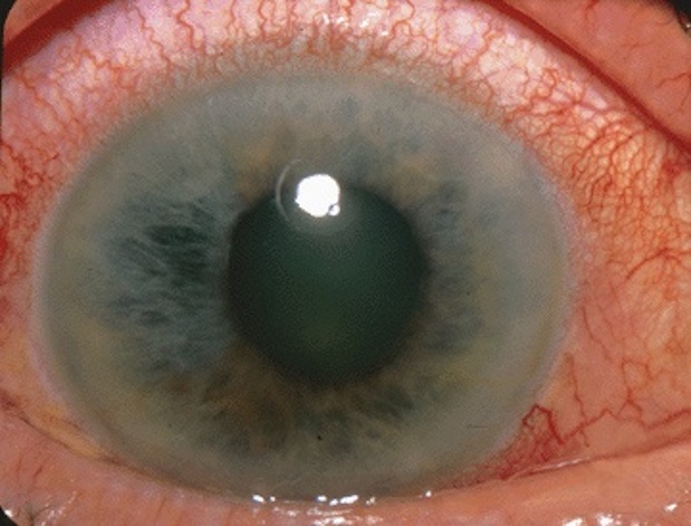 an eye affected by glaucoma