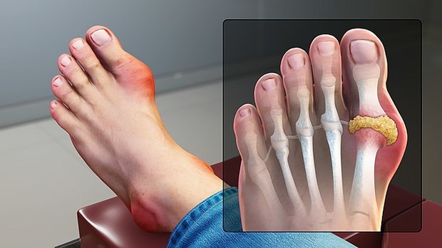 a big toe affected by gout