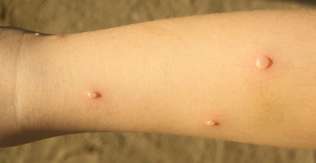 chickenpox blisters on a person’s arm