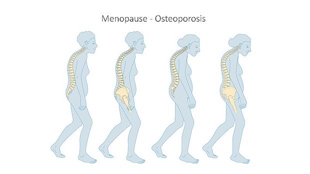 a diagram showing the progression of osteoporosis)