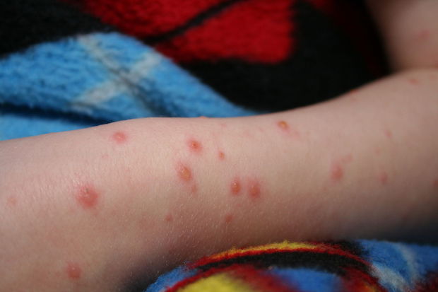 a child’s leg with red chickenpox bumps
